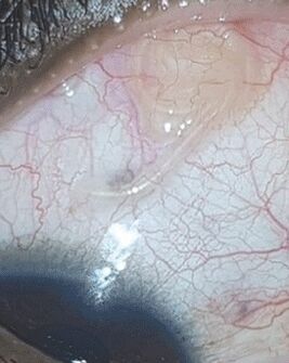 NEOflorax aitas vabaneda ussist silmas